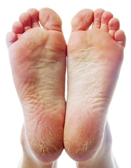 Bàn chân bị nứt nẻ nặng